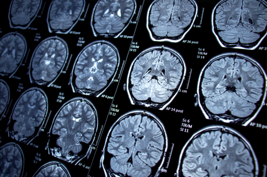 Medical scan images of different brains with disorders. 